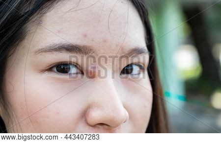 Close-up Of Asian Woman With Pimple (or Elephant Head Acne) And Acne Inflamed On Her Face. Hard Pimp