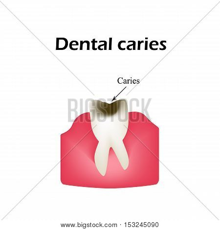 Deep tooth decay. Vector illustration on isolated background.
