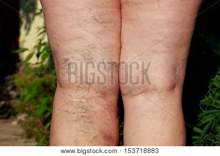 the disease varicose veins on a legs