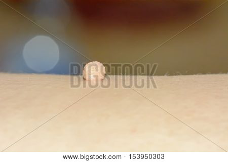Skin Tag Or Acrochondon Or Soft Fibroma