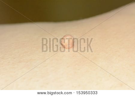 Skin Tag Or Acrochondon Or Soft Fibroma