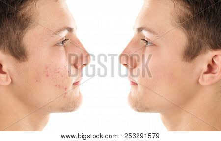 Young Man With Acne Problem On White Background