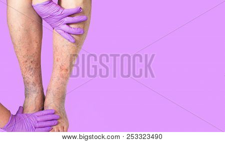 Close-up Of Skin With Varicose Veins On Senior Male Leg. Concept Of Dry Skin, Old Senior People, Var