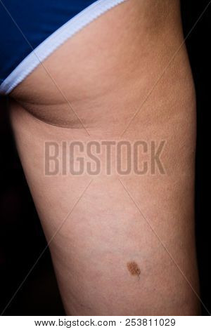 Birthmark On The Female Thigh From Behind. Close-up.