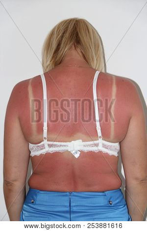 Sunburn From Beach Sun Light On Shoulder And Back Of Caucacian Girl. Woman Sunburn. Female Body. Bod
