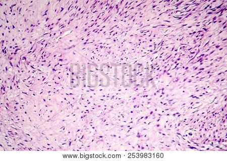 Fibroma, A Benign Tumour Of Fibrous Tissue, Light Micrograph, Photo Under Microscope