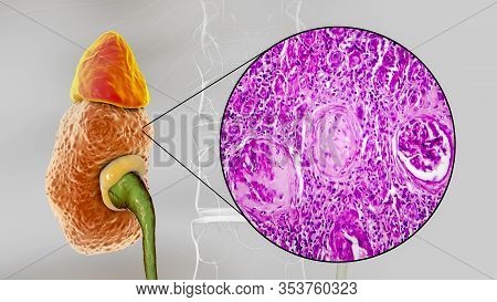 Chronic Glomerulonephritis, 3d Illustration Showing Pale Contracted Coarsely Granular Kidneys And Li
