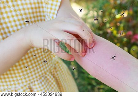 Little Girl Has Skin Rash Allergy And Itchy On Her Arm From Mosquito Bite