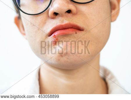 Herpes Labialis Of The Woman Lower Lip. Blisters That Break Open And Form Small Ulcers, Swollen Lymp