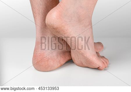 Dry And Cracked Soles Of Feet On Gray Background, Foot With Dry Heels, Cracked Skin Heel Of Foot Wit