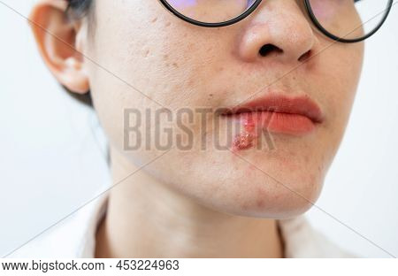 Herpes Labialis Of The Woman Lower Lip. Blisters That Break Open And Form Small Ulcers, Swollen Lymp