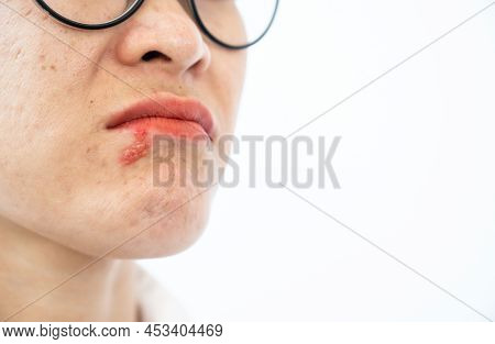 Herpes Labialis Occur On Woman Lower Lip Isolated On White Background.