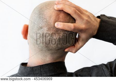 A Man In A Black Shirt Is Holding His Bald Head Covered With Seborrheic Dermatitis And Dandruff. The