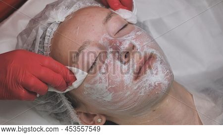 Wipe The Mask Off The Face Of A Girl With Problematic Koja With Cotton Pads.