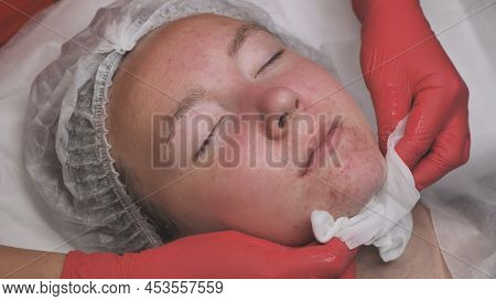 Wipe The Mask Off The Face Of A Girl With Problematic Koja With Cotton Pads.