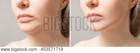 Female Double Chin Before And After Correction. Correction Of The Chin Shape Liposuction Of The Neck