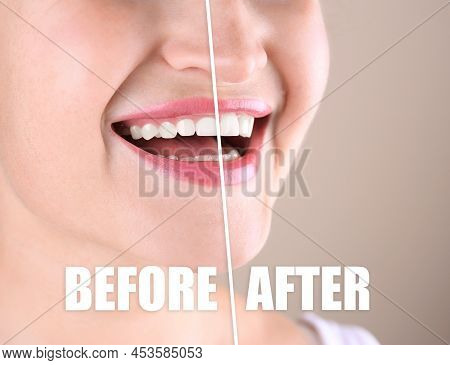 Young Woman Before And After Gingivoplasty Procedure On Beige Background, Closeup
