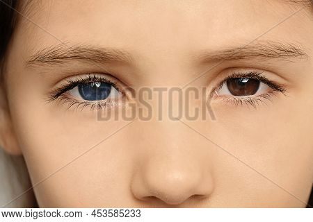 Little Girl With Different Colors Of Eyes, Closeup. Heterochromia Iridis