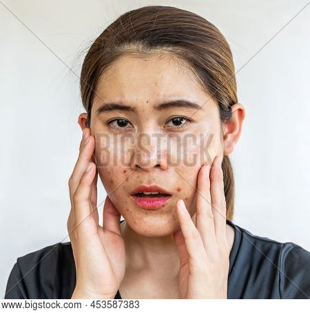 Portrait Of Asian Woman Having Problems Of Oily Skin With Acne Inflamed On Her Face. Oily Skin Is Th