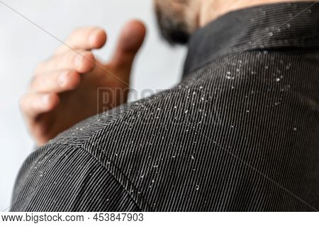 A Bearded Man In A Black Shirt Shakes Dandruff Of His Shoulder. Close-up. The Concept Of Psoriasis A