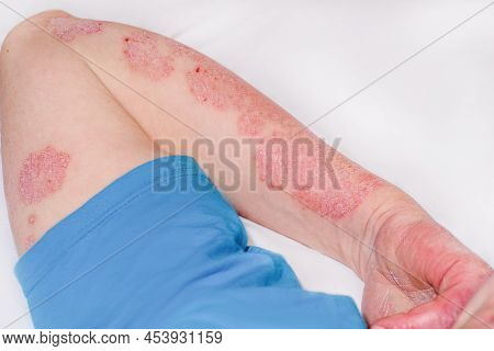 Acute Psoriasis On The Arm Of A Man, Severe Redness On The Skin, An Autoimmune Incurable Dermatologi