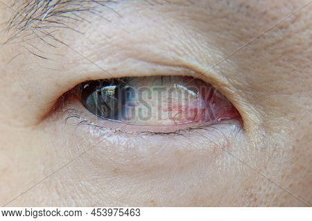 Close-up Asian Man Eye With Eye Irritation.
