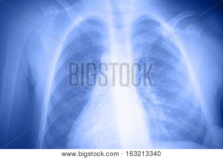 Doctor check a lung x-ray of a patient
