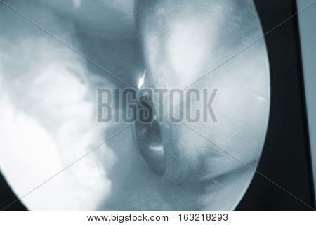 Arthroscopy Surgery Screen