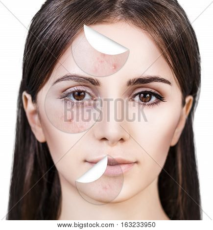 Circles layers of skin with acne unstick from good healthy skin of young woman.