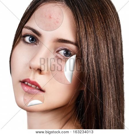 Circles layers of skin with acne unstick from good healthy skin of young woman.