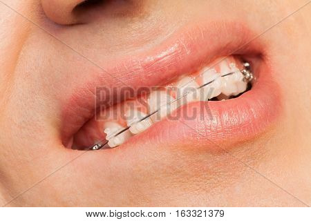 Man showing orthodontics correction of jaws with ceramic dental braces