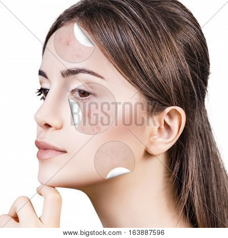 Circles layers of skin with acne unstick from good healthy skin of young woman.
