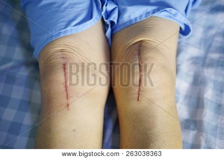 Asian Senior Or Elderly Old Lady Woman Patient Show Her Scars Surgical Total Knee Joint Replacement 