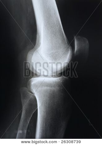 Radiographie du genou