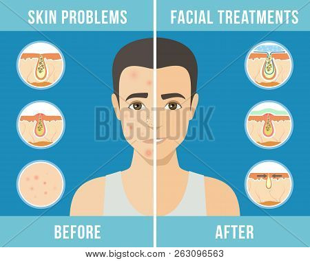 Man With A Problem Skin. Treatment Of Acne, Skin Care, Mens Cosmetics. Vector