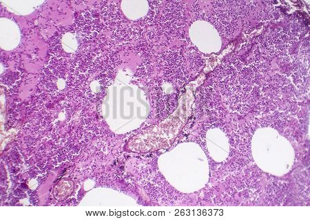 Lobar Pneumonia, Hemorrhagic Edema Period, Light Micrograph, Photo Under Microscope