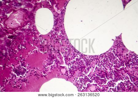 Lobar Pneumonia, Hemorrhagic Edema Period, Light Micrograph, Photo Under Microscope