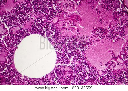 Lobar Pneumonia, Hemorrhagic Edema Period, Light Micrograph, Photo Under Microscope