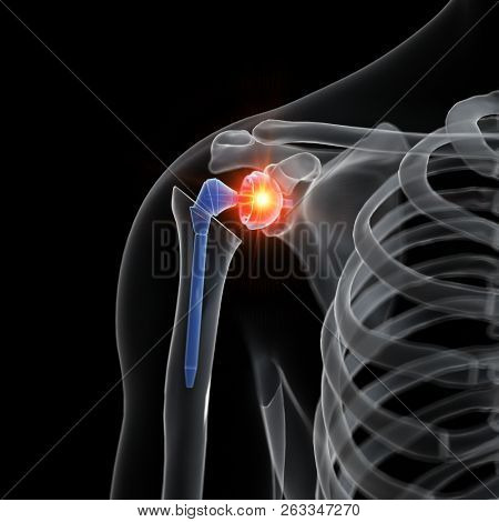3d rendered medically accurate illustration of a shoulder replacement