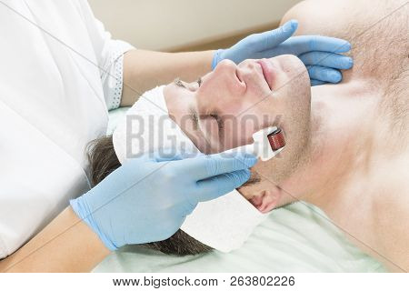 The Man Undergoes The Procedure Of Medical Micro Needle Therapy With A Modern Medical Instrument Der