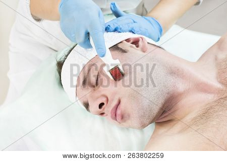 The Man Undergoes The Procedure Of Medical Micro Needle Therapy With A Modern Medical Instrument Der