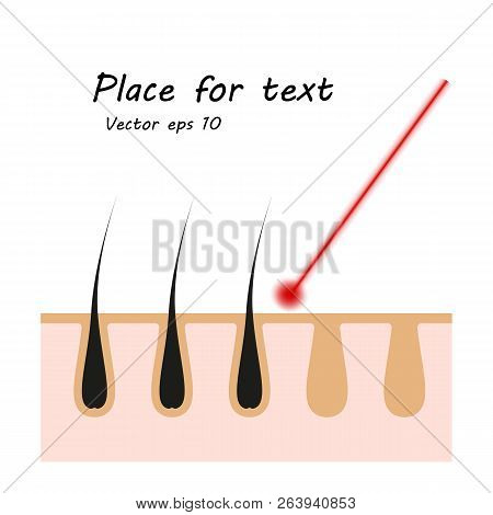 Icon Illustration Of Skin Hair. Vector Element On Isolated Background For Cosmetic Laser Hair Remova