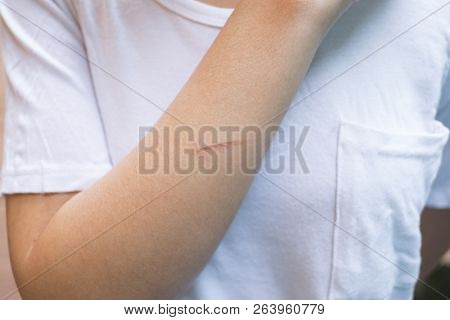 Close Up Of Brown Lesion From Iron. Lesion Burn From Iron.