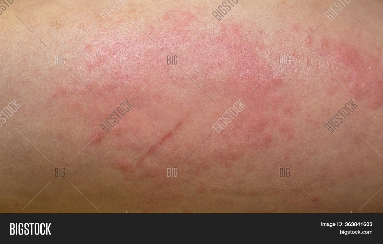 Skin Allergic Reaction Image & Photo (Free Trial) Bigstock