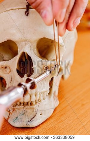 Maxillofacial Surgery. Model Of A Human Skull With A Attach Prosthesis Attached To It For Maxillofac