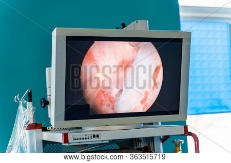 Process Of Surgery Operation Using Laparoscopic Equipment. Operating Room With Surgery Equipment. Me
