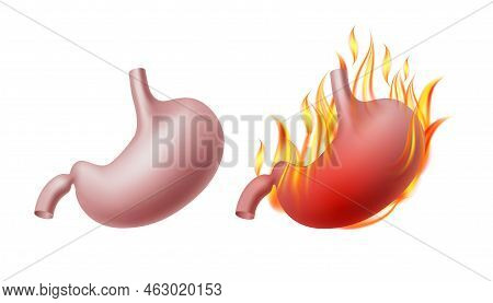 Healthy Human Stomach And Burning Stomach. Vector Illustration