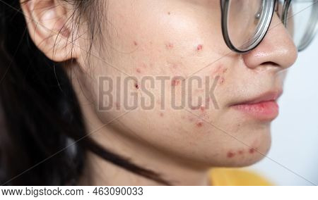 Close Up Of Asian Woman Having Acne Inflamed On Her Face. Inflamed Acne Consists Of Swelling, Rednes