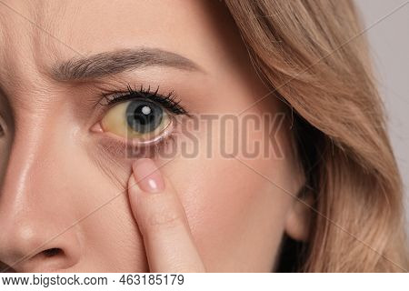 Woman With Yellow Eyes, Closeup. Liver Problems Symptom
