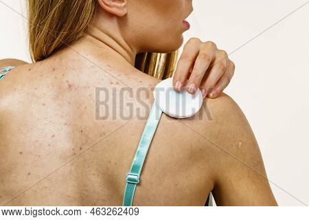 Health Problem, Skin Diseases. Young Woman With Acne, Red Spots On Back. Female Cleaning Skin, Using